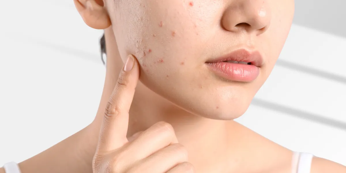 Acne Program