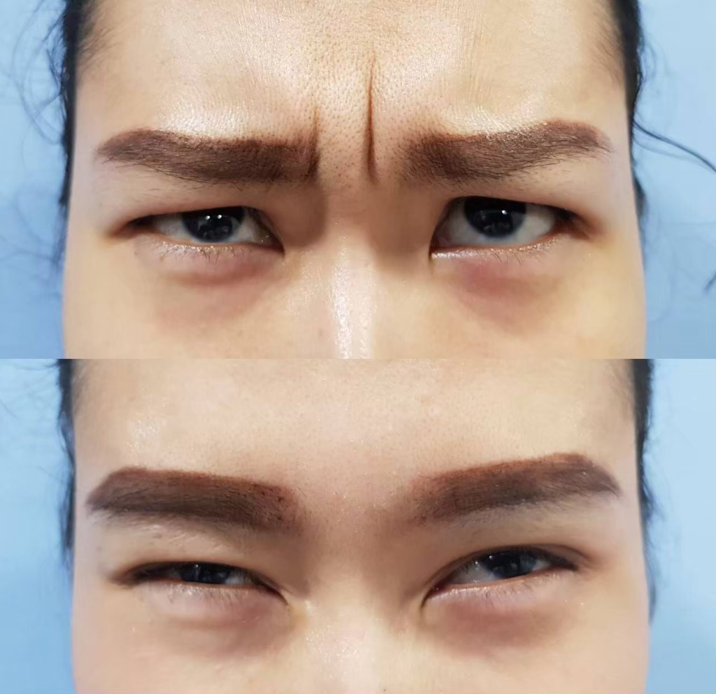 Glabella (Frown Lines) Reduction Result