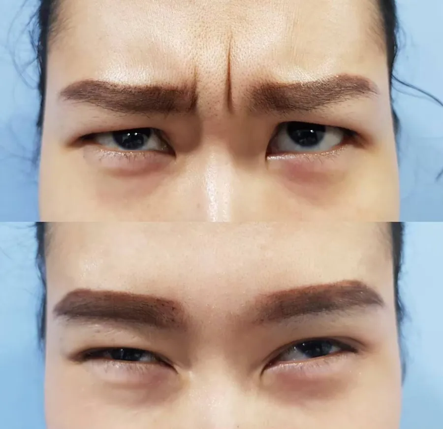Glabella (Frown Lines) Reduction Result