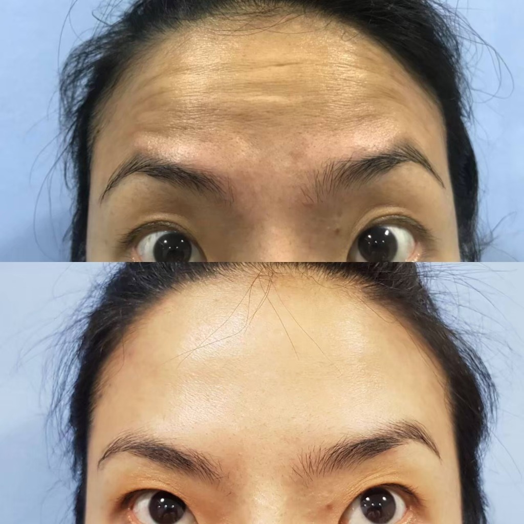 Forehead Lines Smoothing Result
