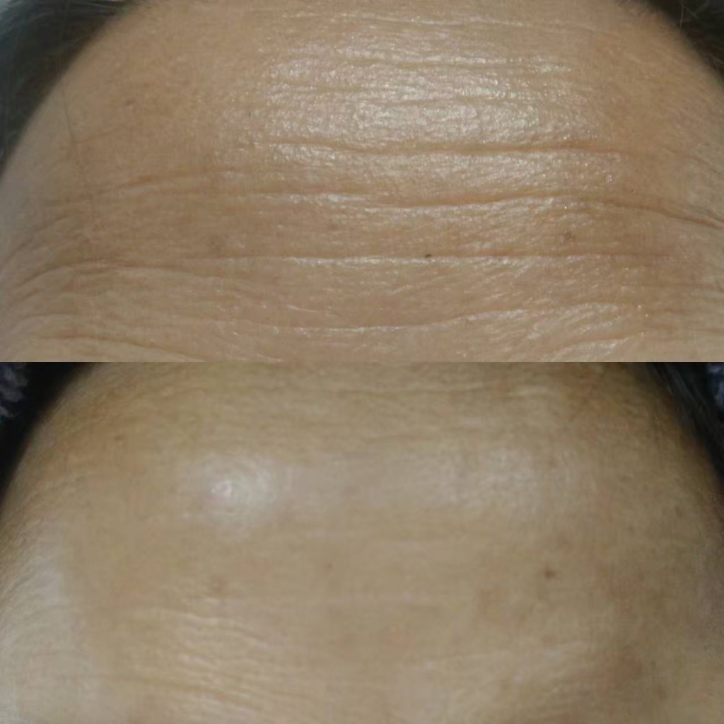 Forehead Fine Lines Reduction Result