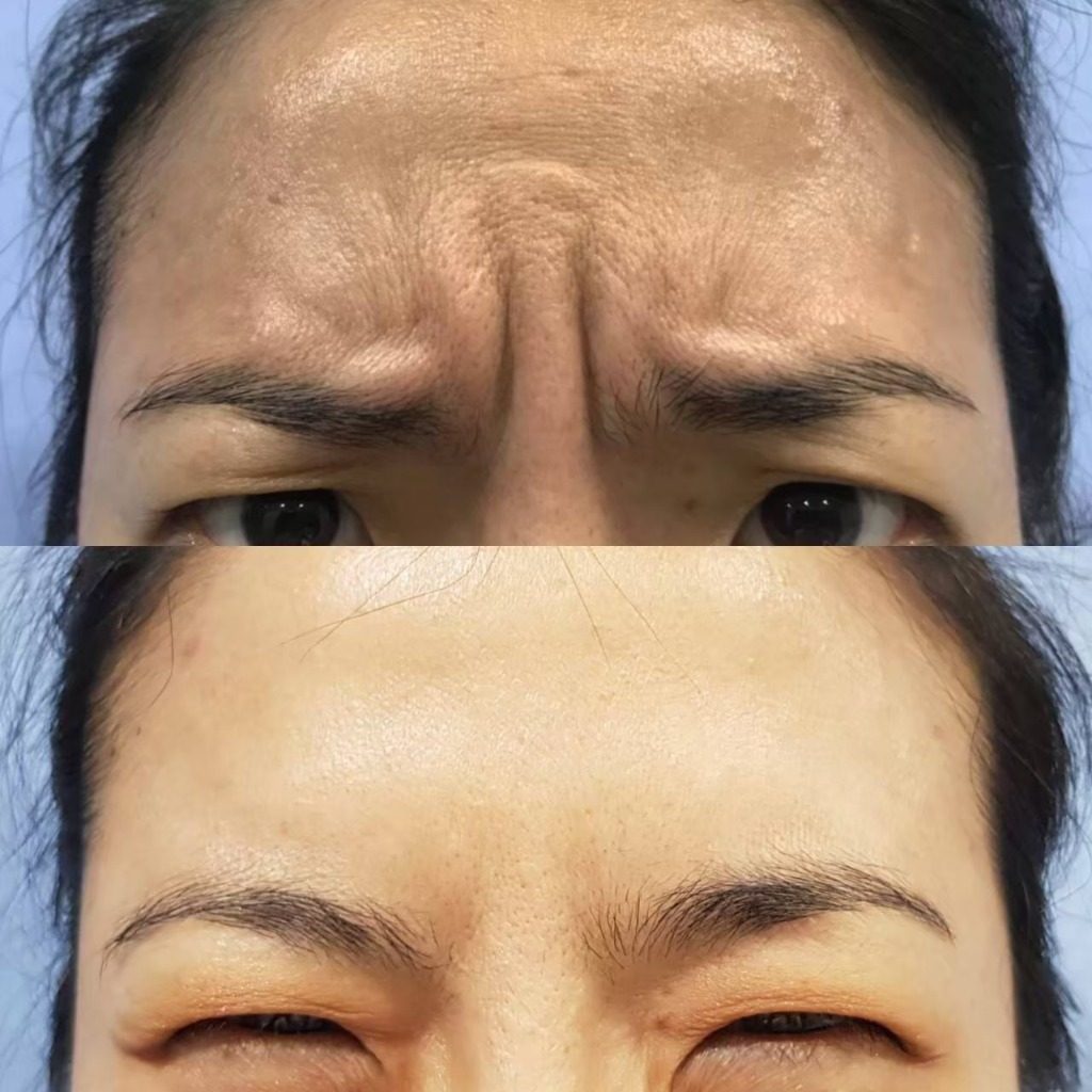 Dynamic Frown Lines Softening Result