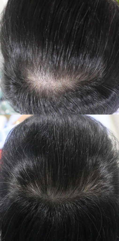 HAIRestart® Result 1