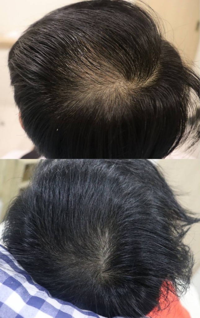 HAIRestart® Result 2