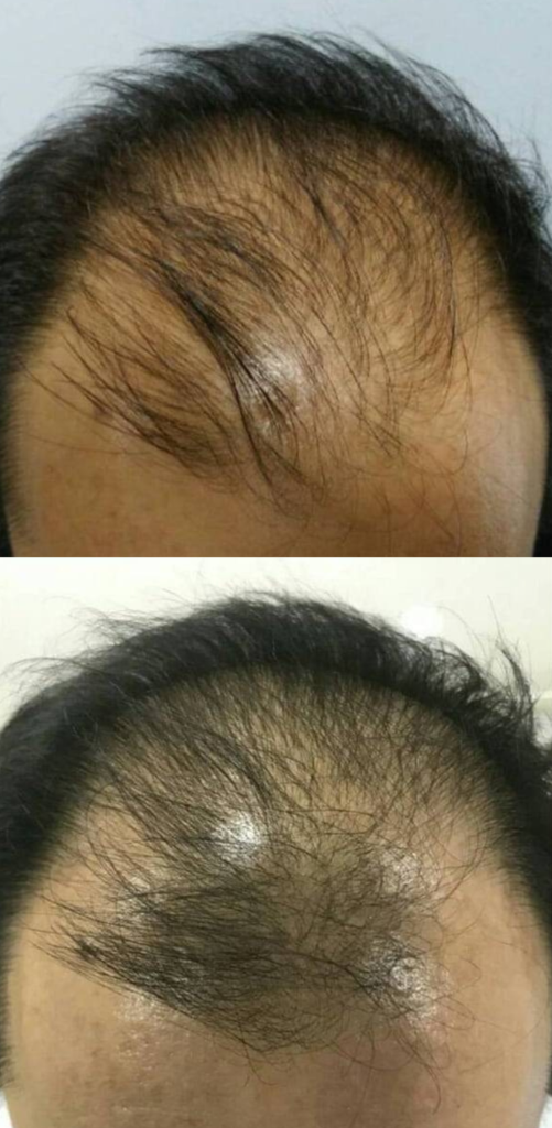 HAIRestart® Result 4
