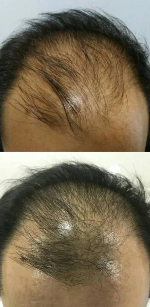 HAIRestart® Result 4