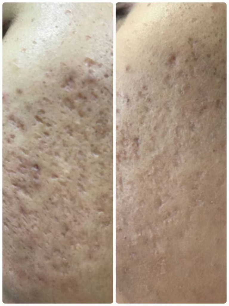 Signature ScarClear Result 1