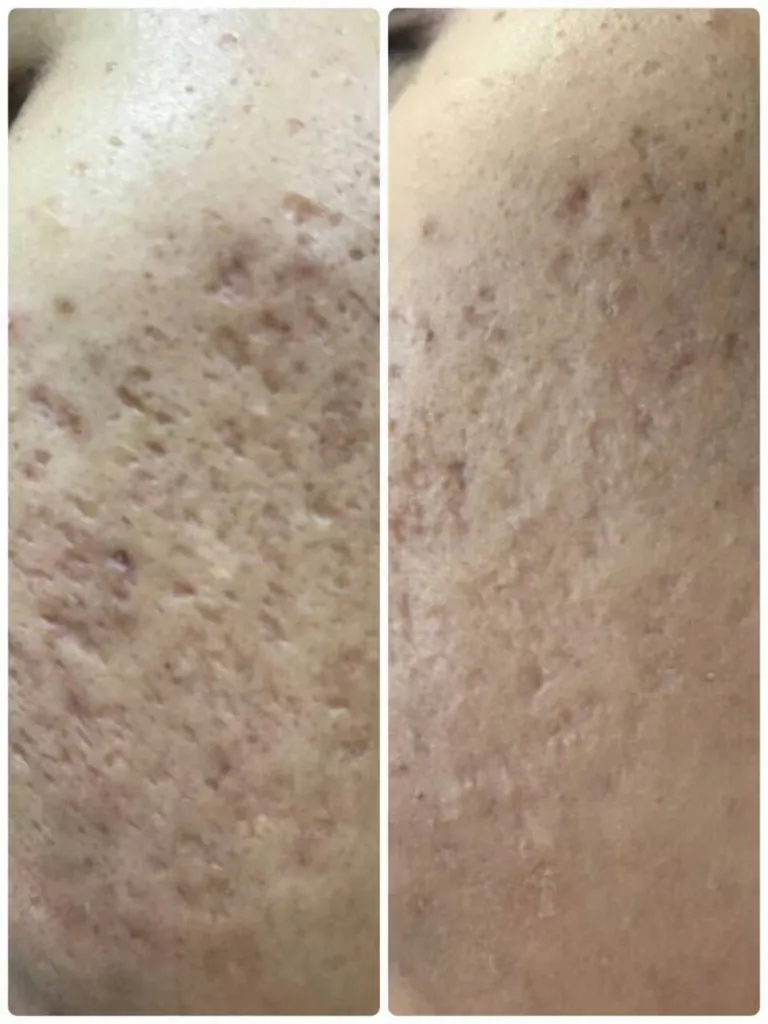 Signature ScarClear Result 1