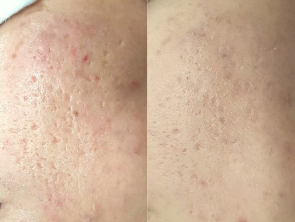 Signature ScarClear Result 2