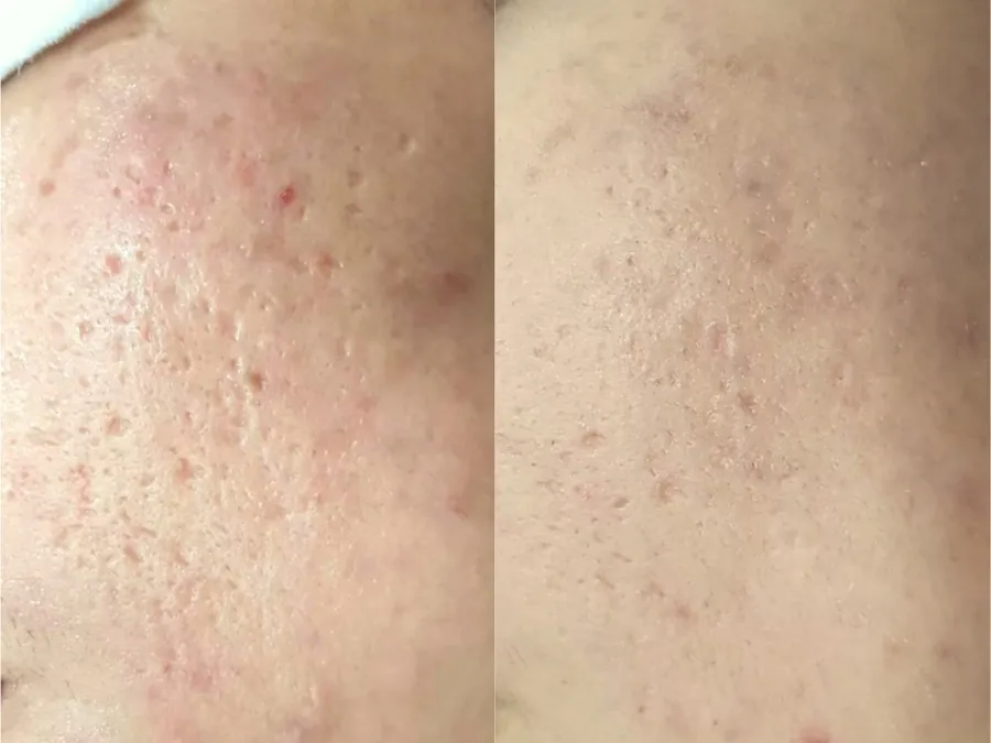Signature ScarClear Result 2