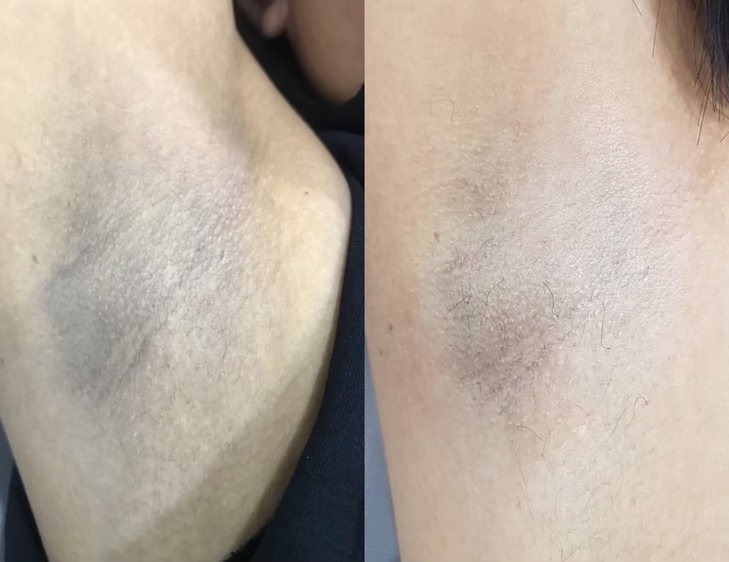 Underarm Complete Care Result