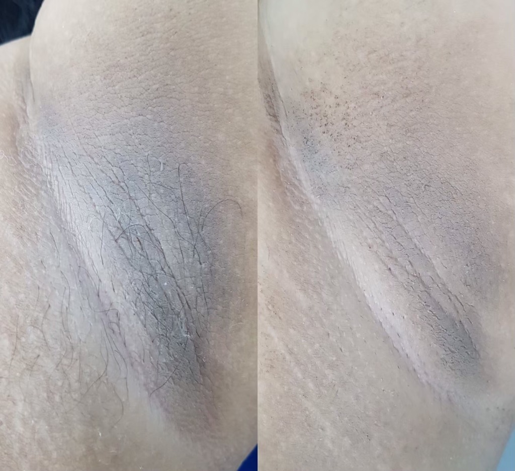 Underarm Whitening Result