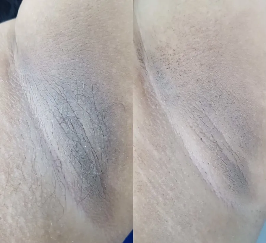 Underarm Whitening Result